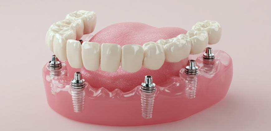 Что такое All-on-4 и All-on-6