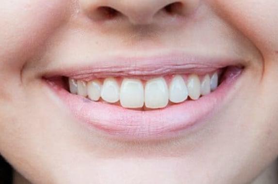 Отбеливание зубов