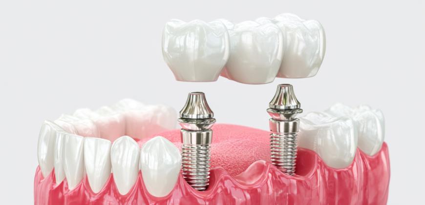 Что такое имплантация зубов